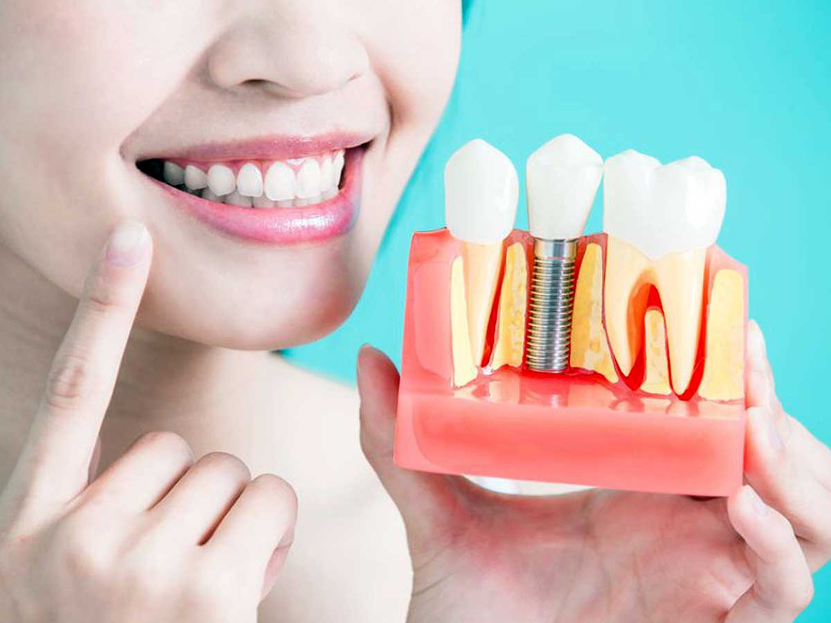 ¿Son doloroso los implantes dentales? (Parte 2 de 2)