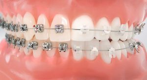 Ortodoncia en Adultos, motivos y recomendaciones