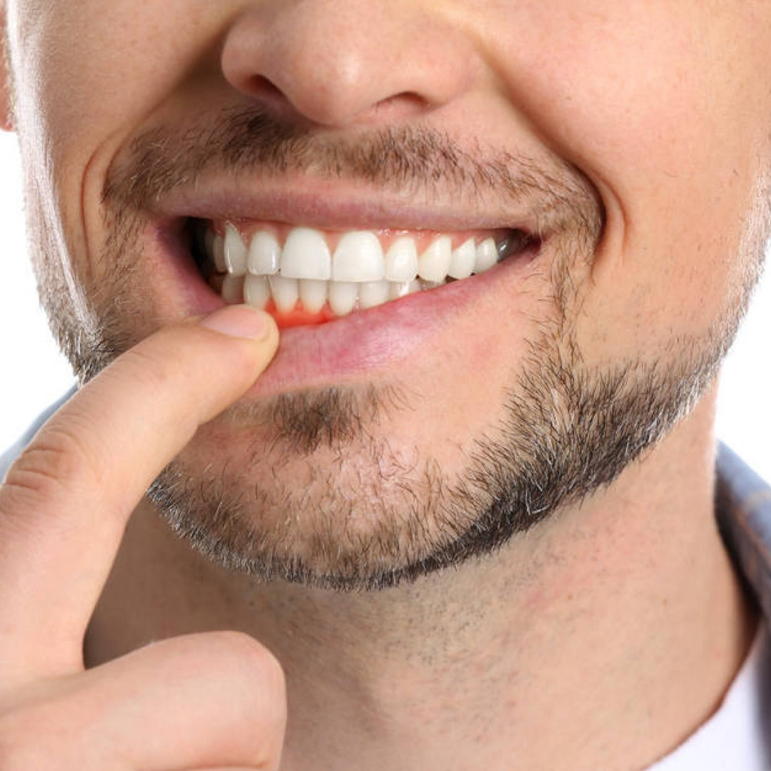 Prevenir, detectar y tratar la gingivitis  Parte 2