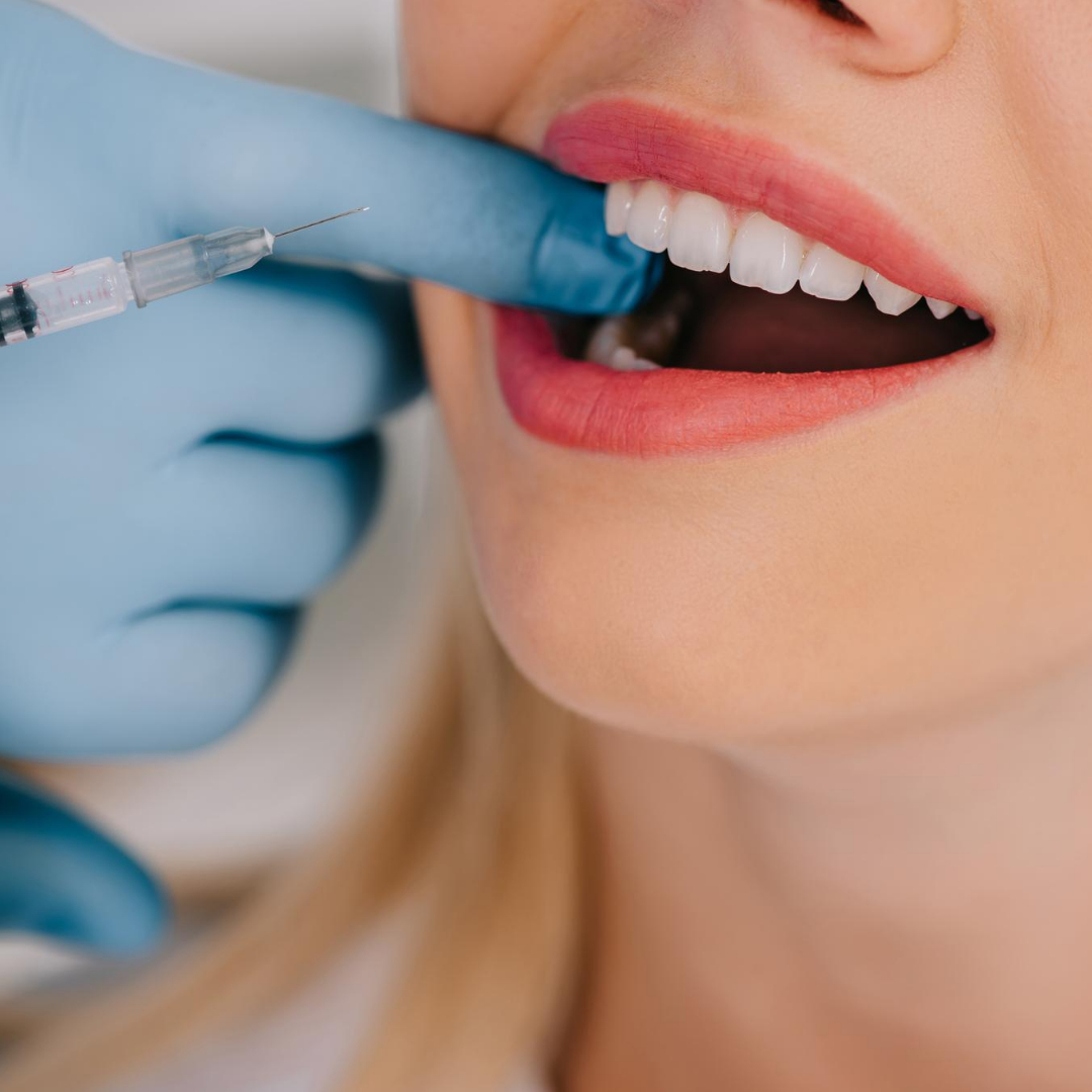 Blanqueamientos dentales: Algunas cosas que debes de saber