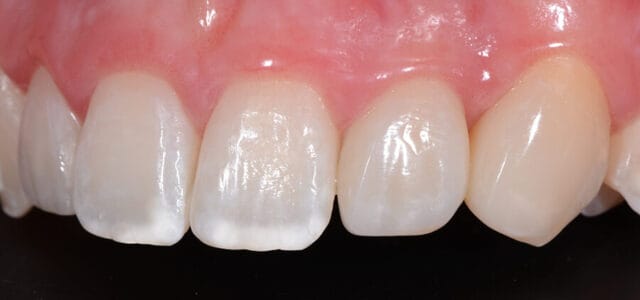 ¿Qué es la hipocalcificación dental y cómo afecta al esmalte?