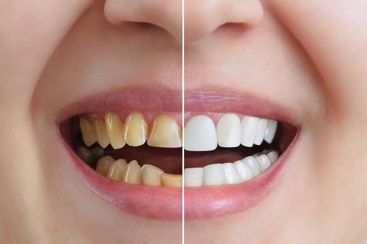 Carillas dentales: Tipos y cuándo usarlas