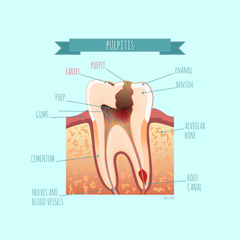 ¿Qué es la pulpitis dental?