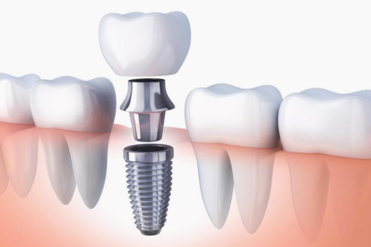 Implantes dentales en Aranjuez - Madrid