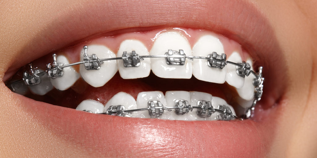 Cómo cuidar los dientes durante un tratamiento de ortodoncia