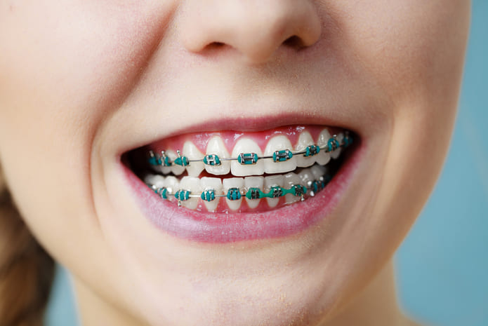 Cuando es necesario usar ortodoncia para corregir problemas dentales pt1