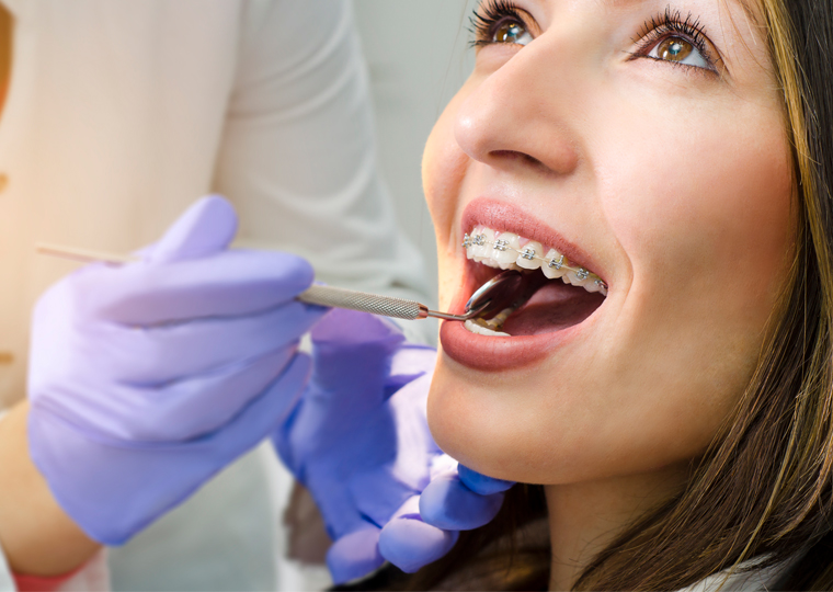Cuando es necesario usar ortodoncia para corregir problemas dentales pt2