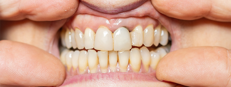 Retracción de encías: causas y tratamiento para cuidar tu salud bucal