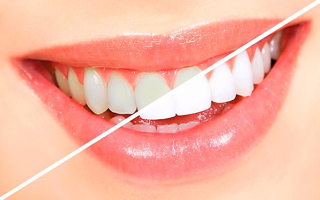 Mantén tu Sonrisa Brillante: Consejos para Conservar el Blanqueamiento Dental